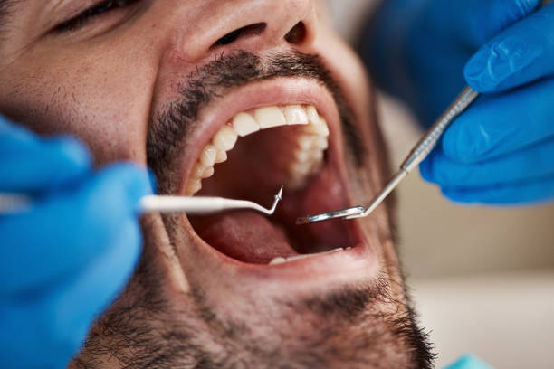 Best Emergency Dental Care for Broken or Chipped Teeth in Alton, IL